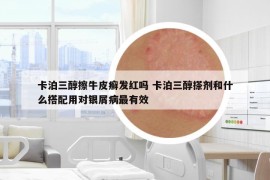 卡泊三醇擦牛皮癬發(fā)紅嗎 卡泊三醇搽劑和什么搭配用對銀屑病最有效