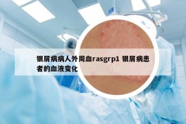 銀屑病病人外周血rasgrp1 銀屑病患者的血液變化