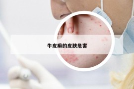 牛皮癬的皮膚危害