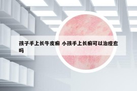 孩子手上長(zhǎng)牛皮癬 小孩手上長(zhǎng)癬可以治痊愈嗎