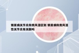 銀屑病關(guān)節(jié)炎和類風(fēng)濕區(qū)別 銀屑病和類風(fēng)濕性關(guān)節(jié)炎有關(guān)聯(lián)嗎