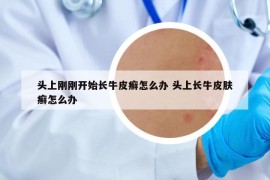 頭上剛剛開始長牛皮癬怎么辦 頭上長牛皮膚癬怎么辦