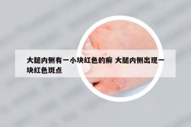 大腿內(nèi)側(cè)有一小塊紅色的癬 大腿內(nèi)側(cè)出現(xiàn)一塊紅色斑點(diǎn)