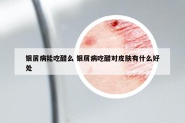 銀屑病能吃醋么 銀屑病吃醋對(duì)皮膚有什么好處