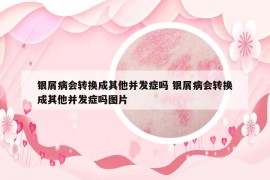 銀屑病會(huì)轉(zhuǎn)換成其他并發(fā)癥嗎 銀屑病會(huì)轉(zhuǎn)換成其他并發(fā)癥嗎圖片