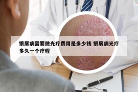 銀屑病需要做光療費(fèi)用是多少錢 銀屑病光療多久一個(gè)療程
