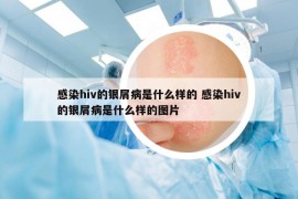 感染hiv的銀屑病是什么樣的 感染hiv的銀屑病是什么樣的圖片