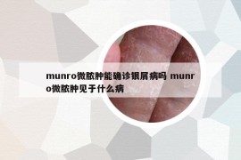 munro微膿腫能確診銀屑病嗎 munro微膿腫見(jiàn)于什么病