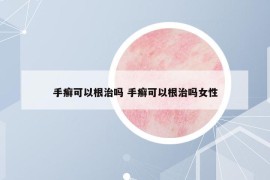 手癬可以根治嗎 手癬可以根治嗎女性