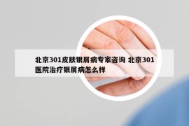 北京301皮膚銀屑病專家咨詢 北京301醫(yī)院治療銀屑病怎么樣