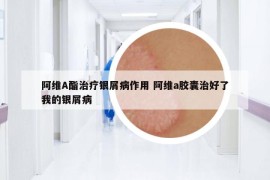 阿維A酯治療銀屑病作用 阿維a膠囊治好了我的銀屑病