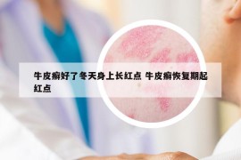牛皮癬好了冬天身上長(zhǎng)紅點(diǎn) 牛皮癬恢復(fù)期起紅點(diǎn)