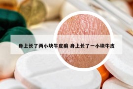 身上長了兩小塊牛皮癬 身上長了一小塊牛皮