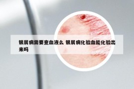 銀屑病需要查血液么 銀屑病化驗血能化驗出來嗎