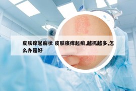 皮膚癢起癬狀 皮膚瘙癢起癬,越抓越多,怎么辦是好