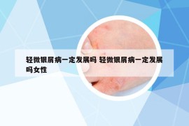 輕微銀屑病一定發(fā)展嗎 輕微銀屑病一定發(fā)展嗎女性