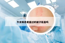 牛皮癬患者蓋過的被子能蓋嗎