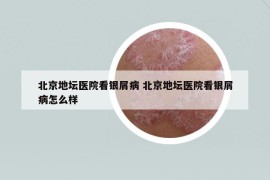 北京地壇醫(yī)院看銀屑病 北京地壇醫(yī)院看銀屑病怎么樣