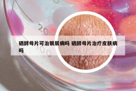 硒酵母片可治銀屑病嗎 硒酵母片治療皮膚病嗎