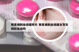 銀屑病刺血拔罐照片 銀屑病刺血拔罐會(huì)發(fā)生同形反應(yīng)嗎