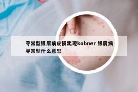 尋常型銀屑病皮損出現(xiàn)kobner 銀屑病尋常型什么意思