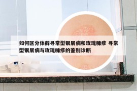 如何區(qū)分體蘚尋常型銀屑病和玫瑰糠疹 尋常型銀屑病與玫瑰糠疹的鑒別診斷