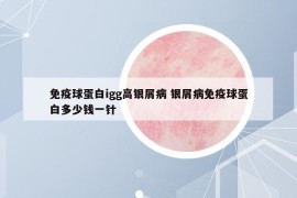 免疫球蛋白igg高銀屑病 銀屑病免疫球蛋白多少錢一針
