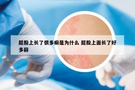 屁股上長(zhǎng)了很多癬是為什么 屁股上面長(zhǎng)了好多蘚