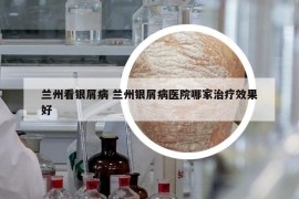 蘭州看銀屑病 蘭州銀屑病醫(yī)院哪家治療效果好