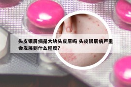 頭皮銀屑病是大塊頭皮屑嗎 頭皮銀屑病嚴(yán)重會(huì)發(fā)展到什么程度?