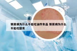 銀屑病為什么不能吃油炸食品 銀屑病為什么不能吃甜食