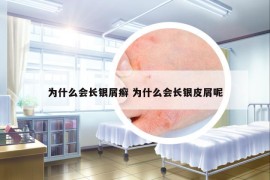為什么會長銀屑癬 為什么會長銀皮屑呢