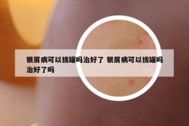 銀屑病可以拔罐嗎治好了 銀屑病可以拔罐嗎治好了嗎
