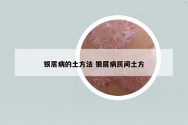 銀屑病的土方法 銀屑病民間土方
