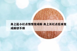 身上起小紅點(diǎn)慢慢變成癬 身上長紅點(diǎn)后來變成癬狀不癢
