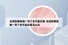 點(diǎn)滴型銀屑病一周了也不起白屑 點(diǎn)滴型銀屑病一周了也不起白屑怎么辦