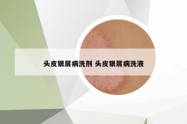 頭皮銀屑病洗劑 頭皮銀屑病洗液