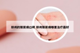 鄭州的銀屑病口碑 鄭州銀屑病哪里治療最好