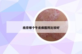 南京哪個牛皮癬醫(yī)院比較好