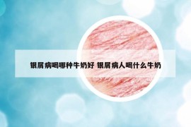 銀屑病喝哪種牛奶好 銀屑病人喝什么牛奶
