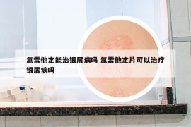 氯雷他定能治銀屑病嗎 氯雷他定片可以治療銀屑病嗎