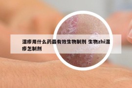 濕疹用什么藥最有效生物制劑 生物zhi濕疹怎制劑