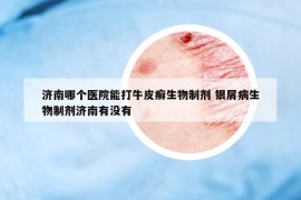 濟(jì)南哪個(gè)醫(yī)院能打牛皮癬生物制劑 銀屑病生物制劑濟(jì)南有沒有