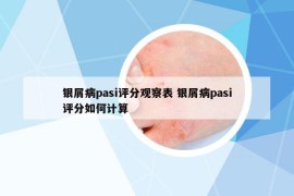 銀屑病pasi評(píng)分觀察表 銀屑病pasi評(píng)分如何計(jì)算