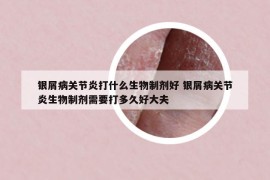 銀屑病關(guān)節(jié)炎打什么生物制劑好 銀屑病關(guān)節(jié)炎生物制劑需要打多久好大夫