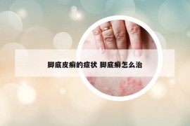 腳底皮癬的癥狀 腳底癬怎么治