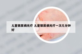 兒童銀屑病光療 兒童銀屑病光療一次幾分鐘好