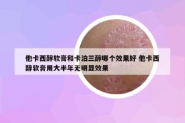 他卡西醇軟膏和卡泊三醇哪個效果好 他卡西醇軟膏用大半年無明顯效果
