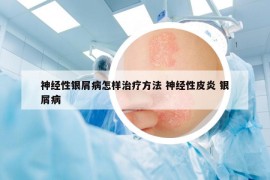 神經(jīng)性銀屑病怎樣治療方法 神經(jīng)性皮炎 銀屑病