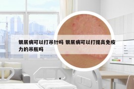 銀屑病可以打吊針嗎 銀屑病可以打提高免疫力的吊瓶嗎